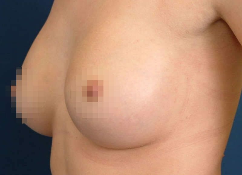 Brustvergroesserung A auf C Körbchen - Beispiel 330 ccm tropfenförmige Implantate, vor dem Muskel bei vorher tief stehenden Brüsten. zB. nach Schwangerschaften.