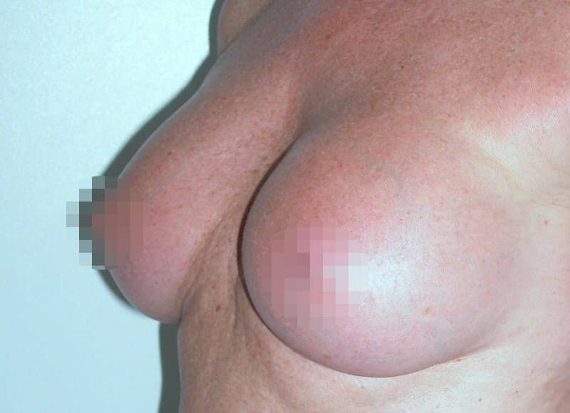 Ergebnis einer Brustvergrößerung A auf D in Hamburg - ein D Körbchen 14 Jahre nach der Operation
