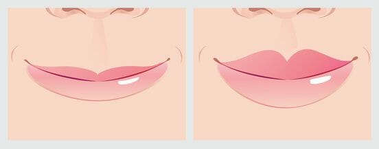 Lippenkorrektur In Hamburg