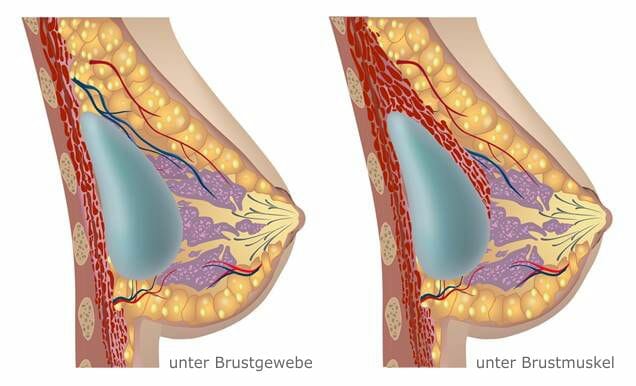 Platzierung der Implantate - entweder unter dem Brustgewebe oder unter dem Brustmuskel