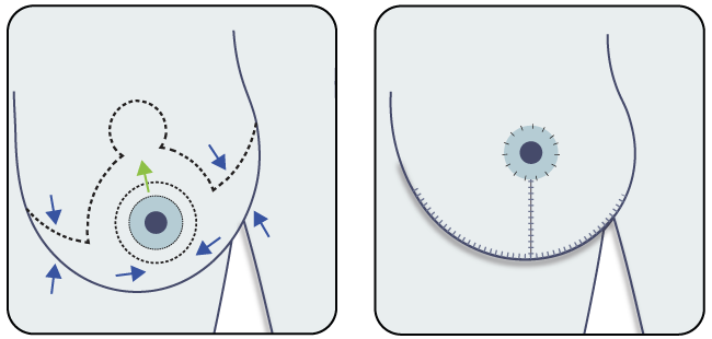 Brustverkleinerung mit inverted T - Stroembeck inverted T